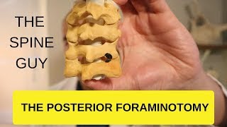 CERVICAL STENOSIS RADICULOPATHY  PART 4  THE POSTERIOR FORAMINOTOMY [upl. by Aihcropal]