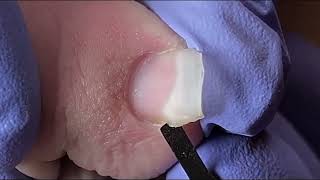 Ingrown Toenail Removal  Pedicure Treatment and Very Satisfying  Best Satisfying Nail Cutting [upl. by Retsevlis117]