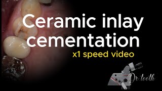 Ceramic inlay cementation procedure X1 speed 세라믹 인레이 세팅 과정 [upl. by Yenal]