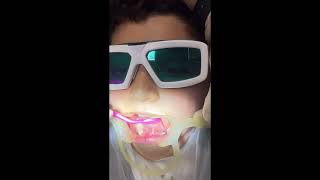 Lingual frenectomy with diode laser epic 10biolase companyby Dr Ali Heidari [upl. by Ayra]