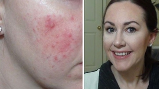 Foundation Routine Rosacea Extreme Redness Acne [upl. by Ahsieken]