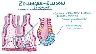 zollinger Ellison syndrome [upl. by Refinnaj]