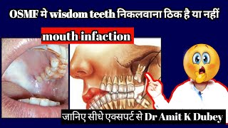 क्या OSMF में wisdom teeth निकलवाना ठिक है या नहीं। osmf treatment in Hindi [upl. by Jeffers]