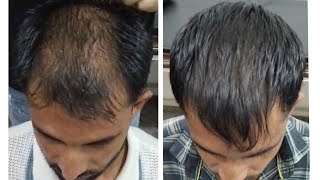 Best hair regrowth। Hairloss Treatment । Dr Danish Chauhan। hairloss HairFall baldness [upl. by Iseabal]