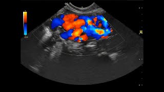 Pelvic congestion syndrome [upl. by Mani996]