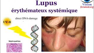 Lupus érythémateux Systémique Signes cliniques Biologiques physiopathologie [upl. by Shep]