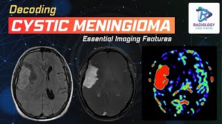 Decoding Cystic Meningioma  Dr Umamaheswara Reddy V [upl. by Roscoe842]