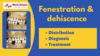 Fenestration and Dehiscence l Periodontal anatomy l Mediklaas [upl. by Laurens]