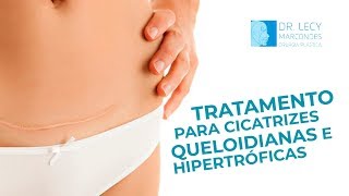 Como tratar e melhorar o aspecto das cicatrizes Queloides e Hipertróficas Cirurgião Dr Lecy explica [upl. by Eeldarb]