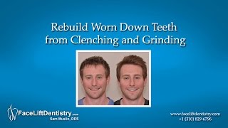 Rebuild Worn Down Teeth from Clenching and Grinding [upl. by Bilicki252]