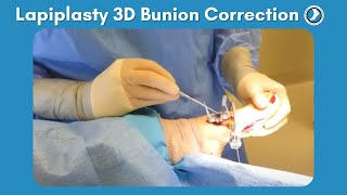 Lapiplasty Procedure  3D Bunion Correction with Dr Paul Steinke [upl. by Laresa]