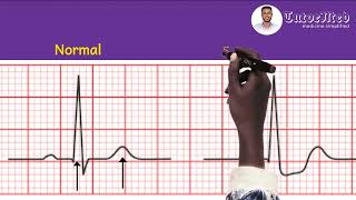 ECG changes of Unstable Angina amp NSTEMI  TutorMed electrocardiogram nstemi unstableangina usmle [upl. by Rossuck]