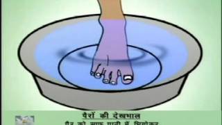 Selfcare of Feet in Leprosy Hindi [upl. by Alamat]