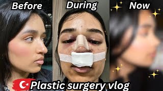 i got a rhinoplasty in TURKEY amp documented my entire recovery nose job vlog [upl. by Petite]