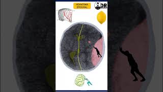 HEMATOMA EPIDURAL  HEMATAMOS INTRACRANEALES  Medicina en 1 minuto Shorts [upl. by Haydon411]