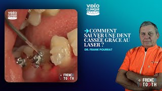 Comment sauver une dent cassée grâce au Laser   Dr Pourrat [upl. by Ert]