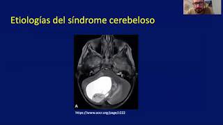 Cerebeloso y vestibular [upl. by Kobi]