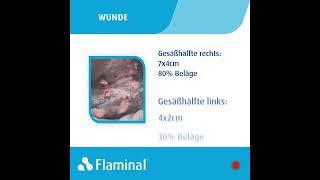 Fallbericht  Behandlung eines Dekubitus der Kategorie 3 mit Flaminal® [upl. by Aved]