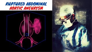 Ruptured Abdominal Aortic Aneurysm [upl. by Adnolat842]