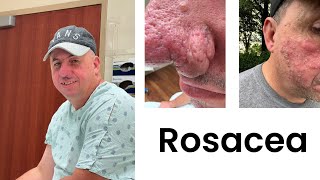 WHAT IS ROSACEA Living With Rosacea And The Affects From It [upl. by Terbecki]