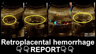 Retroplacental hemorrhage  description  Ultrasound  Report  Amader hospital [upl. by Aidahs]