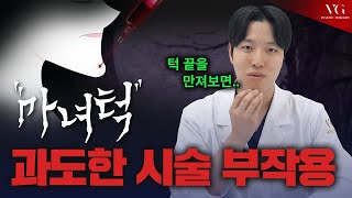 턱 끝도 처진다는 것을 알고 계시나요ㅣ 마녀턱에 대한 모든 것 [upl. by Zanas]