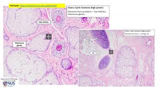 Ovary  Mature cystic teratoma [upl. by Naihtsirc188]