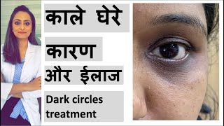 डार्क सर्कल का ईलाज  आखो के काले घेरे के कारण  Dark Circle Treatment  home remedy dermatologist [upl. by Ayinat]