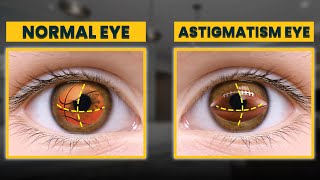 How To Manage and Treat Astigmatism in 2024  Eye Expert Advice [upl. by Atteuqram]