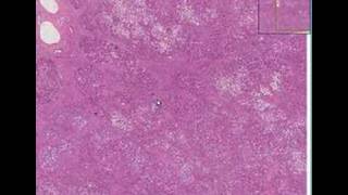 Histopathology LiverCirrhosis micronodular [upl. by Karlow]