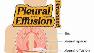 How to Diagnose Pleural Effusion  Free Fluid in BL Lungs  Chest Lung Ultrasound [upl. by Sutit42]