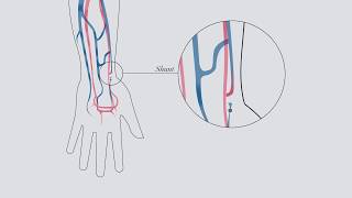 Understanding hemodialysis [upl. by Wehner]