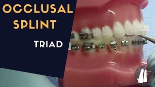 OCCLUSAL SPLINT [upl. by Brucie144]