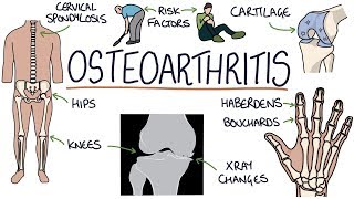 Understanding Osteoarthritis [upl. by Cheri364]