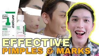 EFFECTIVE OXECURE PREBIO SERUM amp ACNE CLEAR POTION REVIEW  7 DAYS NA TEST  SIR LAWRENCE [upl. by Atela]