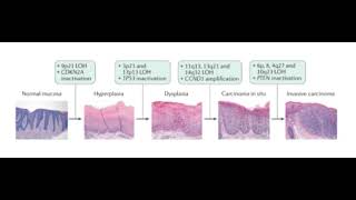 Progression of Squamous cell Carcinoma [upl. by Notlew]