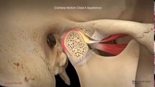 Carriere® Motion Clear™ Appliance with Clear Aligners Patient Education Animation [upl. by Layla790]