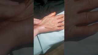 Scleroderma  Hard sclerotic skin  Sclerodactyly [upl. by Anairad]