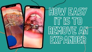 How Easy It Is To Remove an Expander shorts [upl. by Elleinwad]