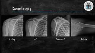 Proximal Humerus Fracture [upl. by Salohcin]