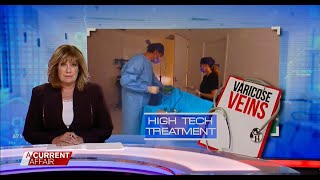 Hitech varicose vein treatments offer hope  A Current Affair [upl. by Mahgem]