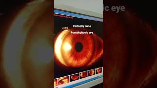 pseudophakia  ophthalmology case [upl. by Irret]