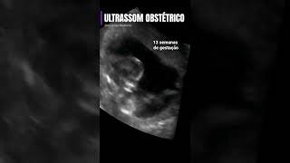 13 SEMANAS DE GESTAÇÃO  Ultrassom obstétrico [upl. by Iolande]