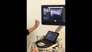 Echografie van de inguinale hernia  advanced course MSU [upl. by Kubis633]