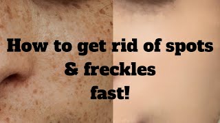 Get rid of freckles and spots FAST  PERMANENT RESULTS [upl. by Furlong]