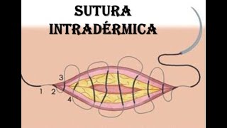 Sutura Intradérmica [upl. by Deraj240]