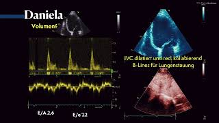 Diastolische Dysfunktion PWDoppler amp Volumenstatus im Ultraschall 〖Ultraschall〗 💘💫 [upl. by Ahsiuqal]