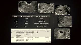 Échographies précoces critères de datation MAlthuser [upl. by Elpmid972]