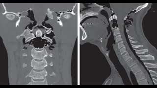 Idiopathische kraniozervikale Hyperpneumatisation mit Pneumorrhachis [upl. by Artemas566]