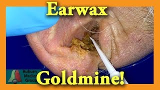 Earwax GOLDMINE  Auburn Medical Group [upl. by Dachi]